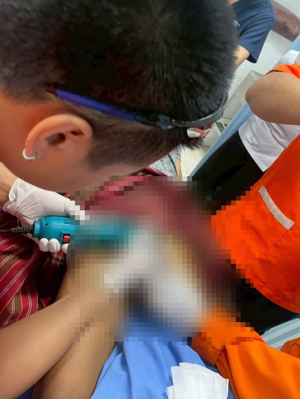 怕天赋异禀命根被偷 自锁双环 肿如拳头险坏死 怕天赋异禀命根被偷 自锁双环 肿如拳头险坏死