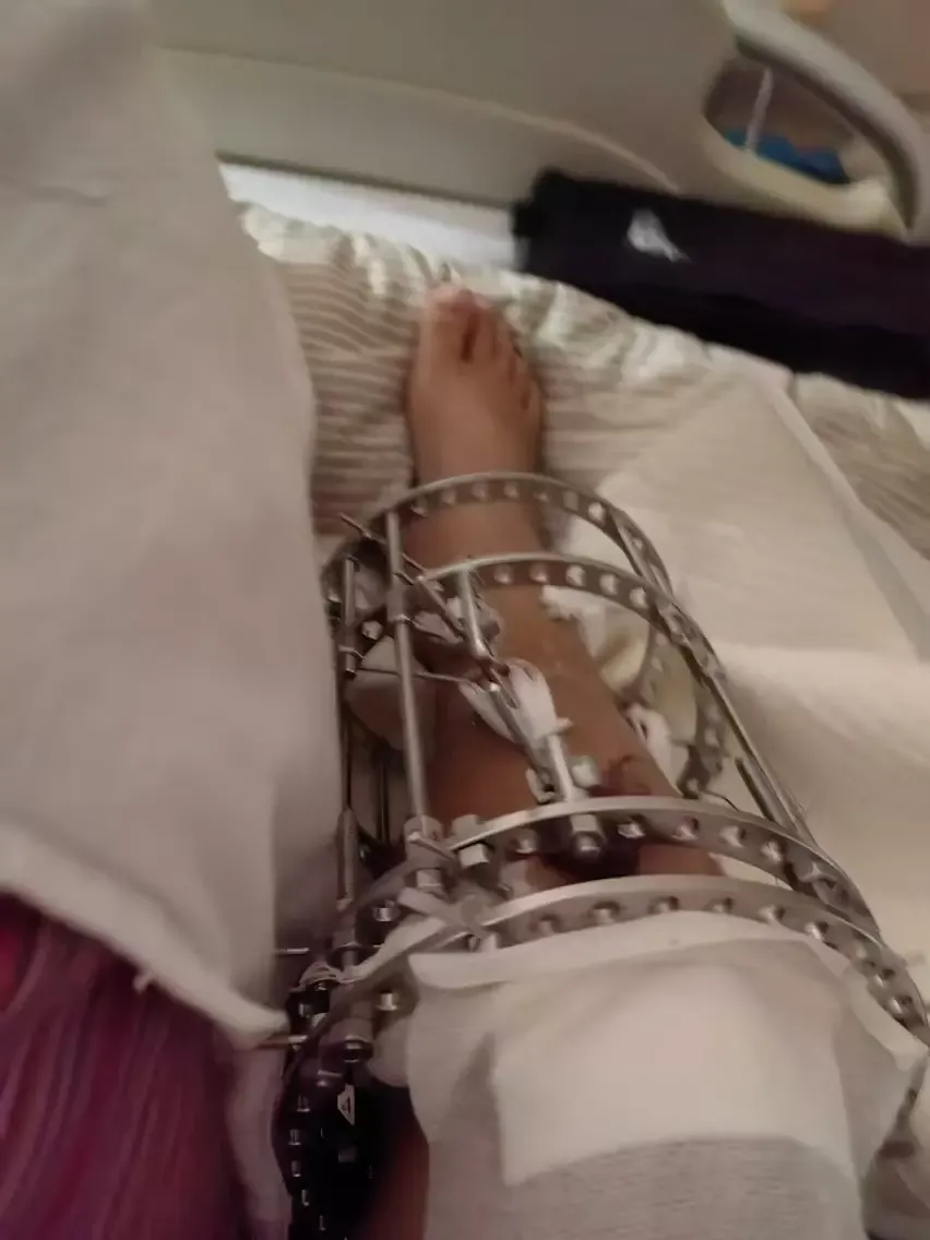 河南患者“断骨增高致瘸”追踪:涉事医院及科室遭罚