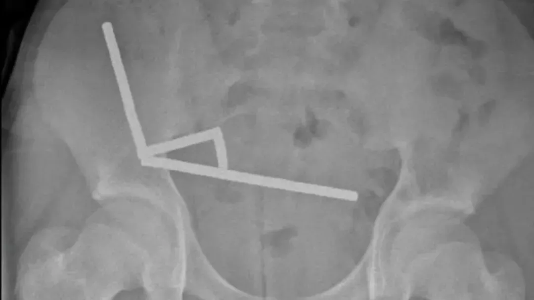 他吞下200块强力磁铁 X光照出惊人画面