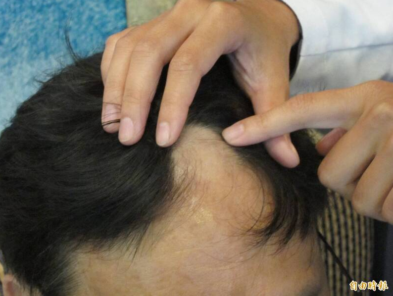 湾科学家研发出只需要20天就能生发的精华液，意外引发大批国外网友热议。示意图，与本文无关。（资料照）