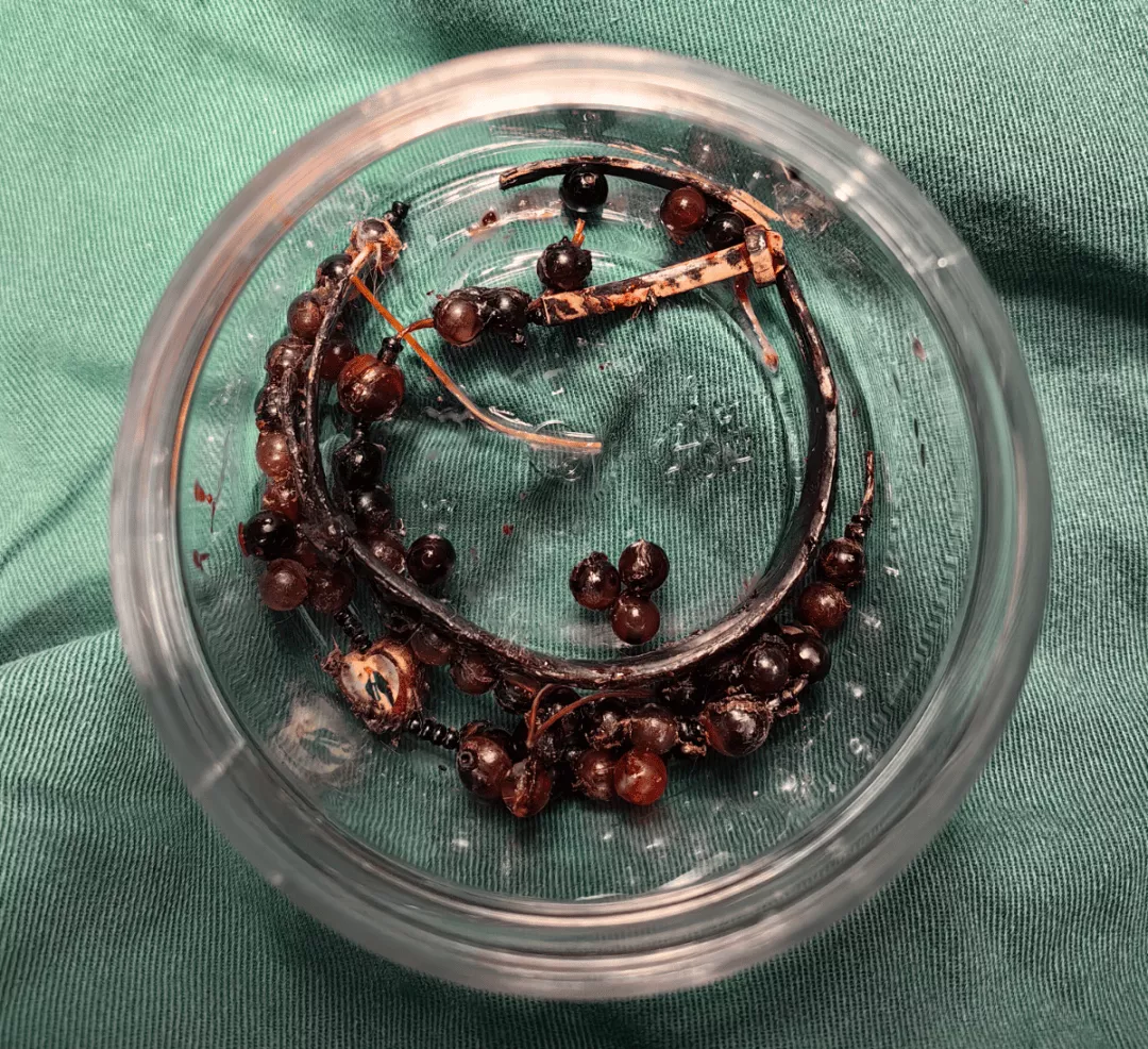 33岁女子戴手镯10年不摘，长胖后嵌进肉里