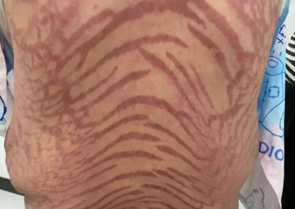 号称治百病!40岁女狂擦“网红神药”全身布满蛇纹 医师揭惊人成分