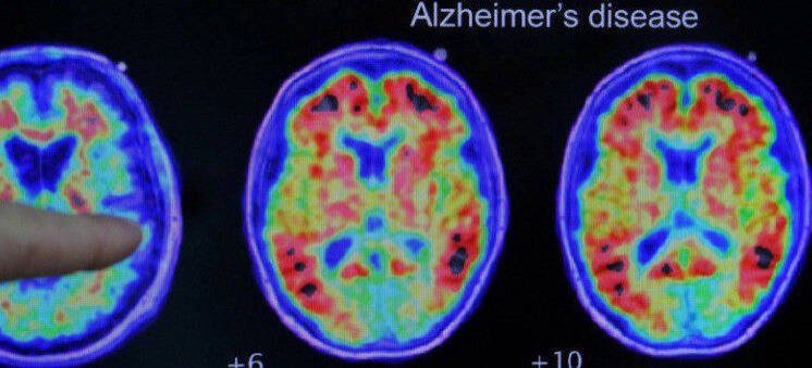 研究发现，口服精胺酸可以成功减少阿兹海默症动物模型中Aβ的累积及其有害影响。图为阿兹海默症扫描图。（路透）